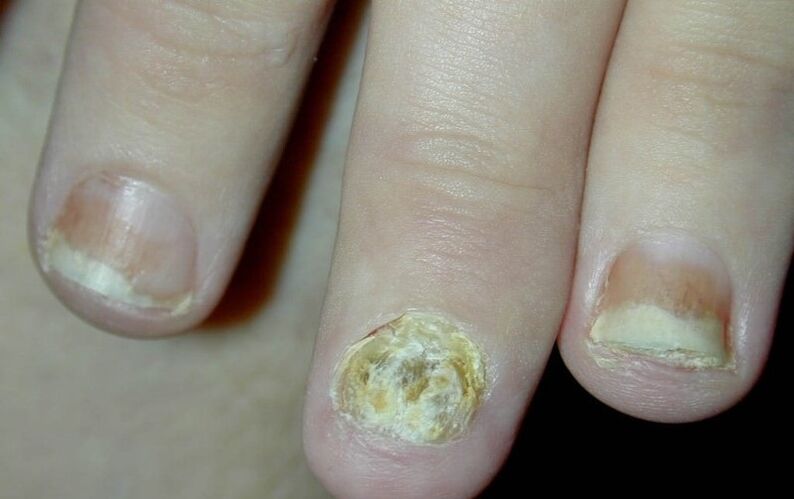 psoriasis of nails on hands