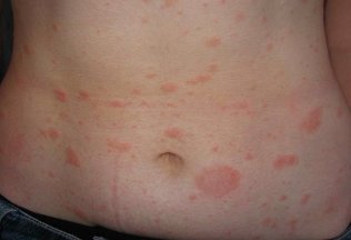 How to treat psoriasis on body