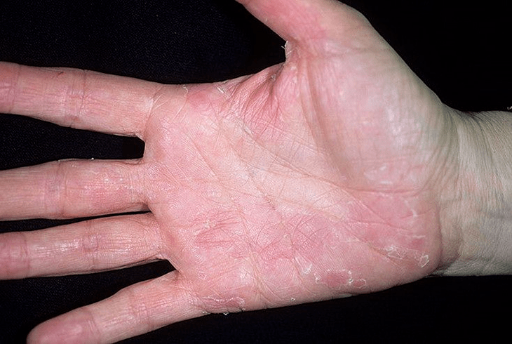 psoriasis of the palms and underneath