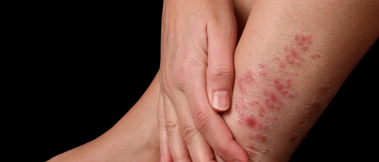 Psoriasis plaques on the skin of the leg