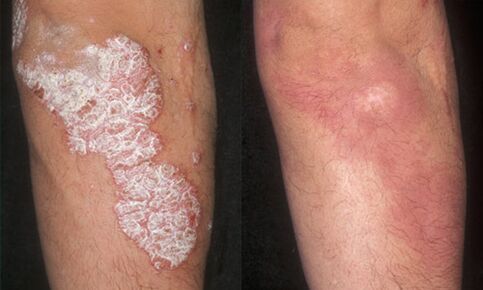 photos before and after psoriasis treatment