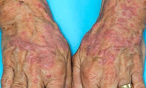 psoriasis on the hands