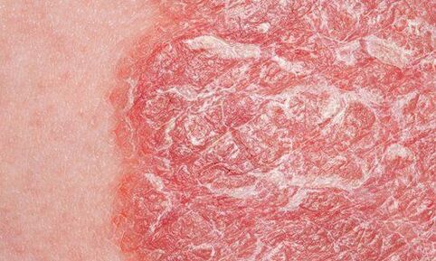 psoriasis on the skin photo 1