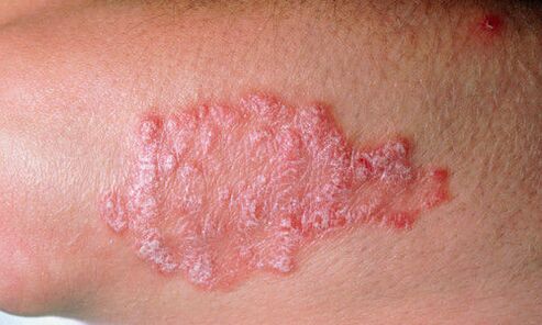 psoriasis on the skin photo 2