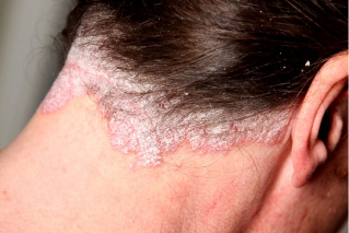 nappy psoriasis of the scalp