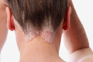 why is there a nappy psoriasis of the scalp