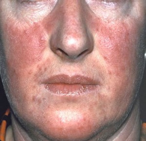 how to treat psoriasis on the face
