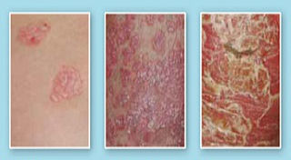 stages of psoriasis