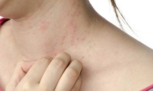 treatment of psoriasis in an advanced stage