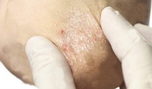 treatment of psoriasis in the attenuation stage