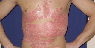 instructions for the comprehensive treatment of psoriasis
