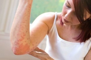 psoriasis from stress