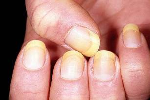 psoriasis of nails