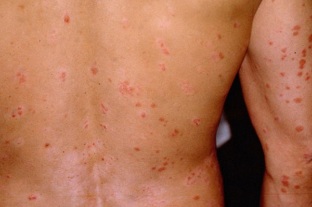 psoriasis initial stages